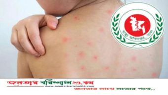 হাম ও হামের উপসর্গে মৃত্যু ৫০০ ছাড়ালো