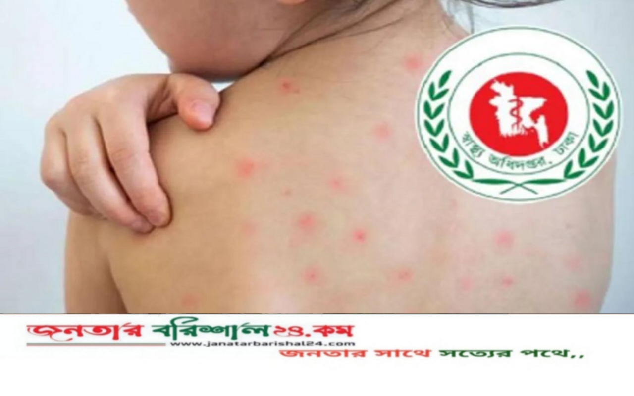 হাম ও হামের উপসর্গে মৃত্যু ৫০০ ছাড়ালো